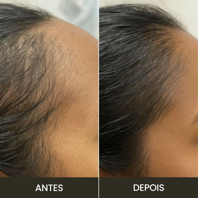 Escova de Terapia Capilar: Queda de Cabelo = TheraBrush Smarts 4 em 1