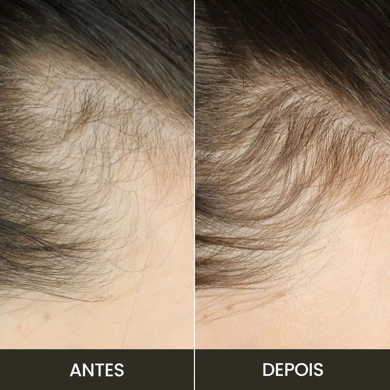 Escova de Terapia Capilar: Queda de Cabelo = TheraBrush Smarts 4 em 1